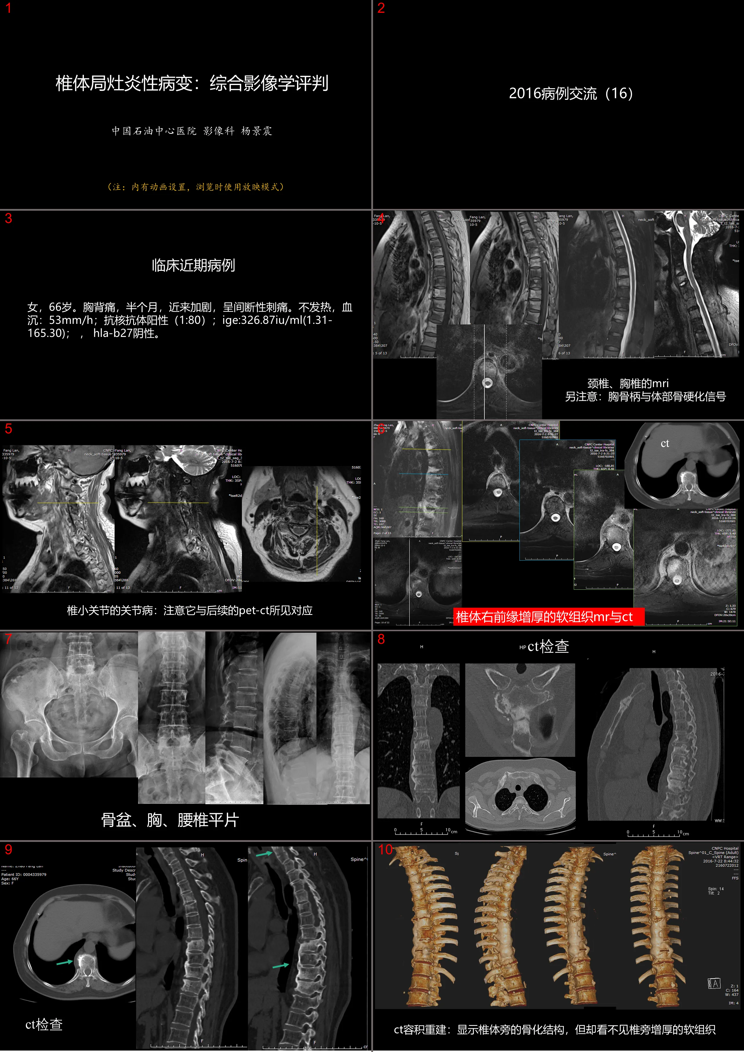 椎體局部病變：綜合影像學評判