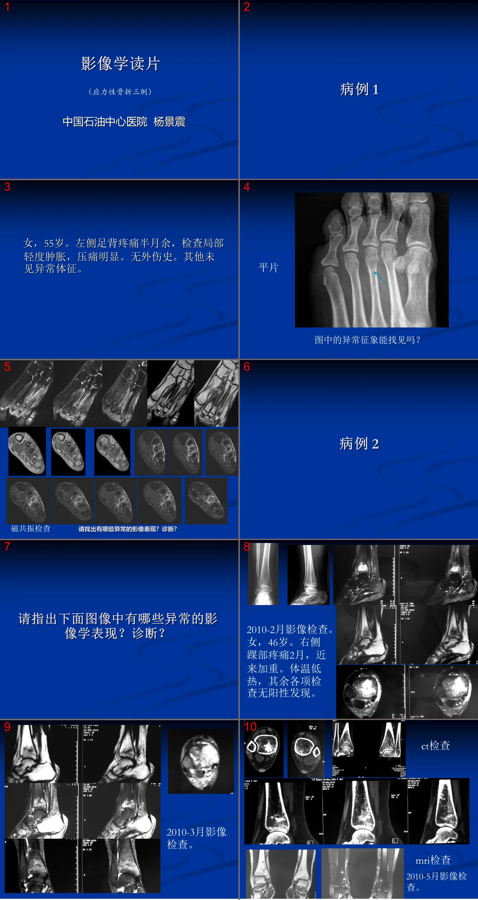 Imaging Case Reading-Stress Fracture