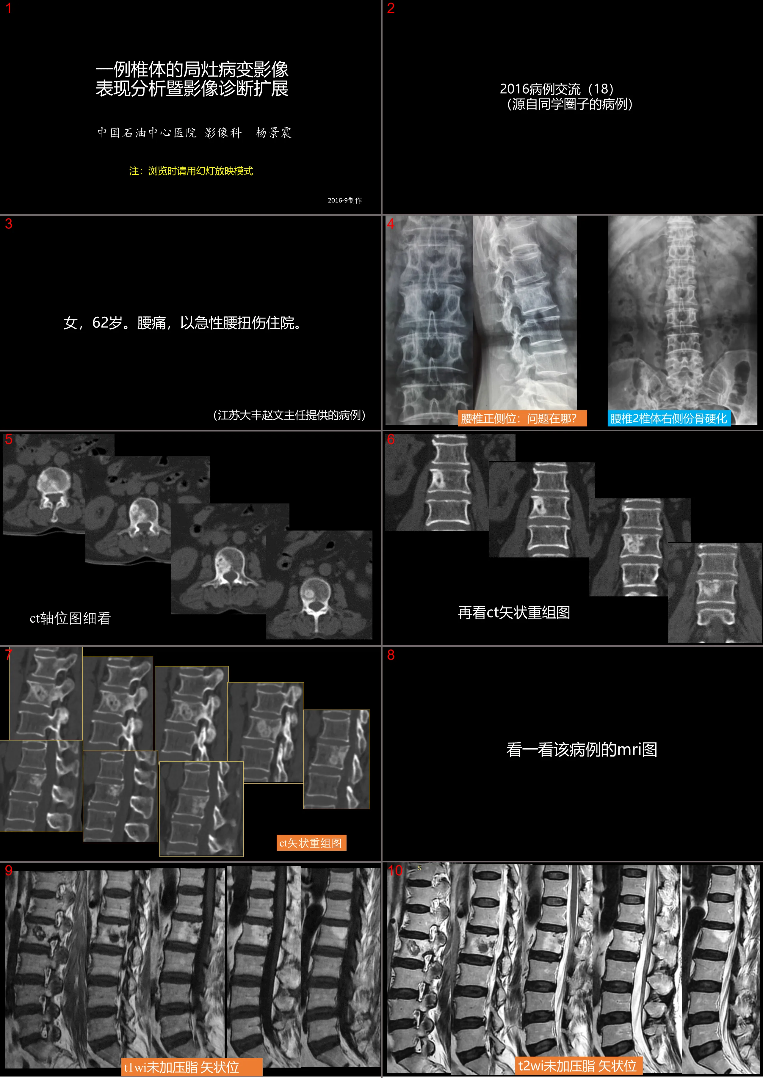 一例椎体的局灶病变影像表现分析暨影像诊断扩展