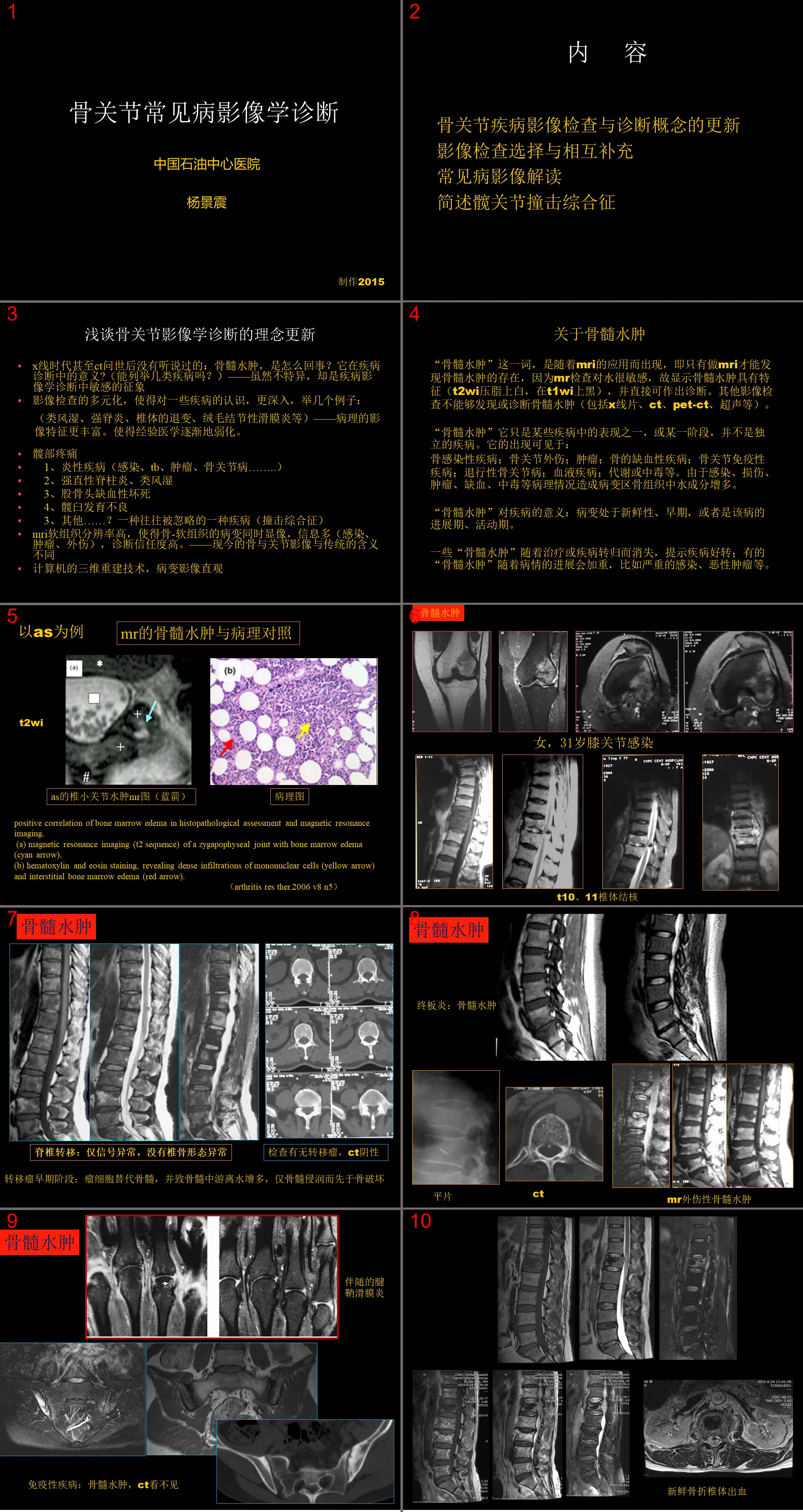 骨與關節常見疾病影像診斷