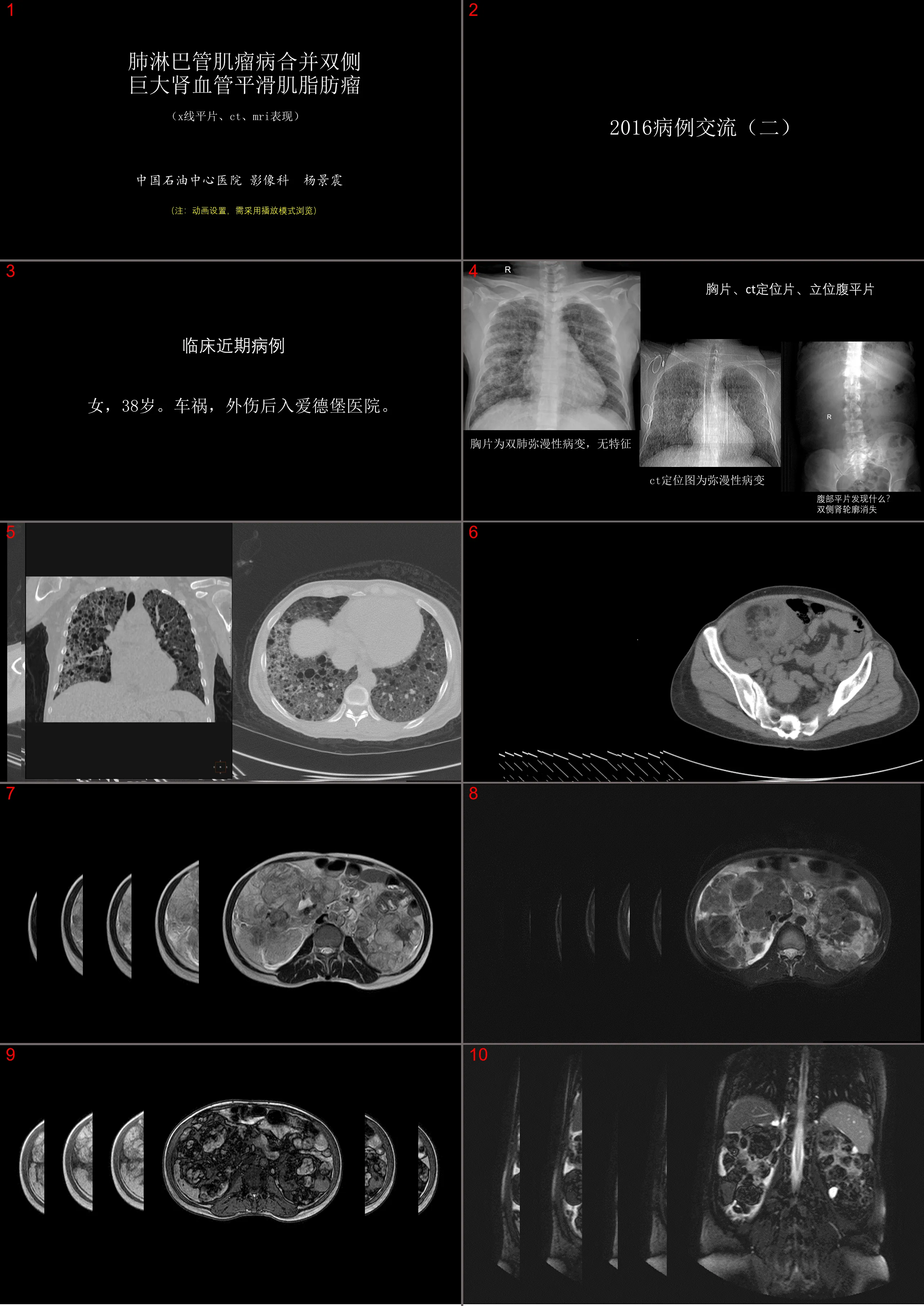 Pulmonary lymphangioleiomyomatosis combined with bilateral giant renal angiomyolipoma (X-ray, CT, MR)