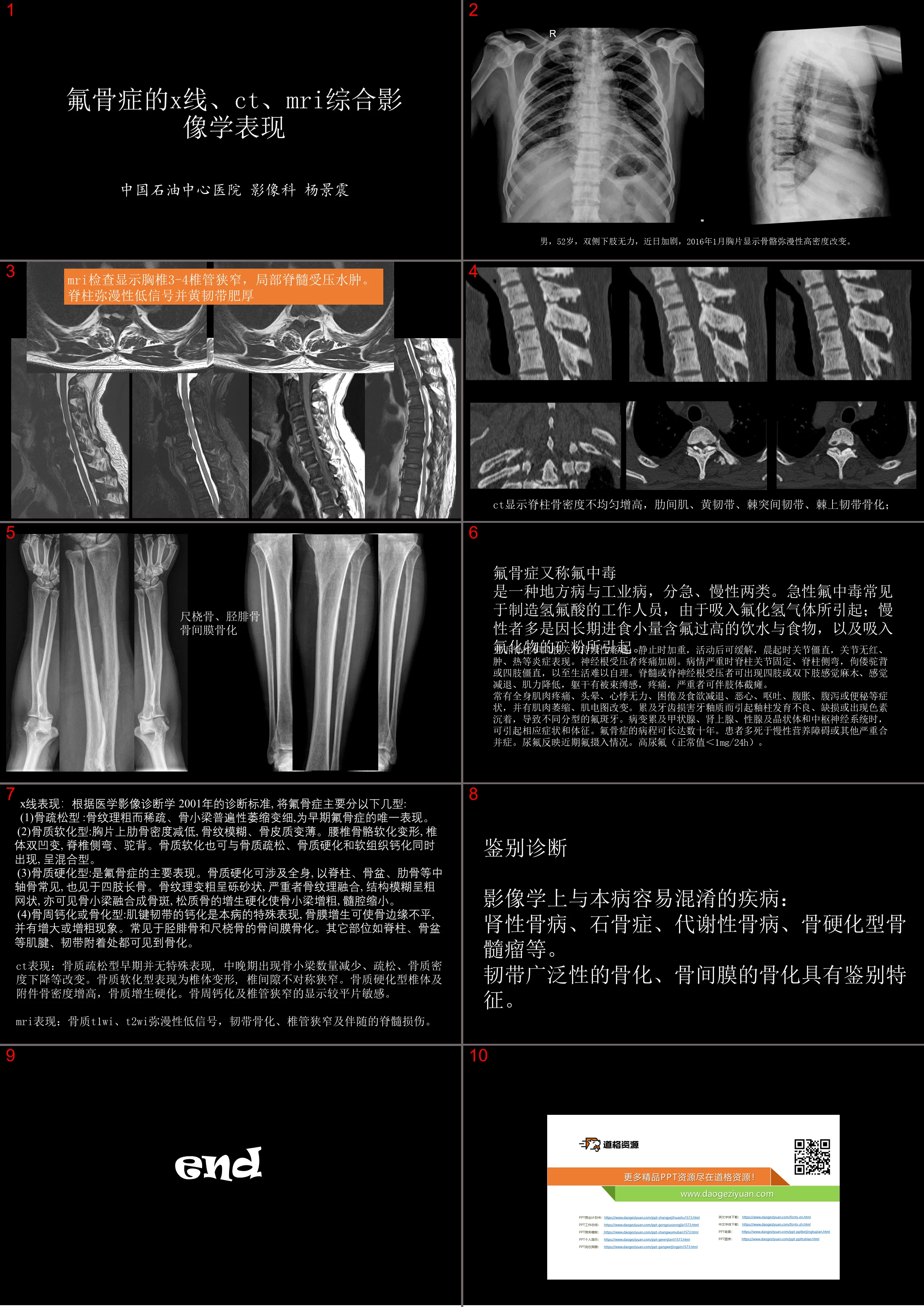 X-ray CT and MR imaging and interpretation of skeletal fluorosis