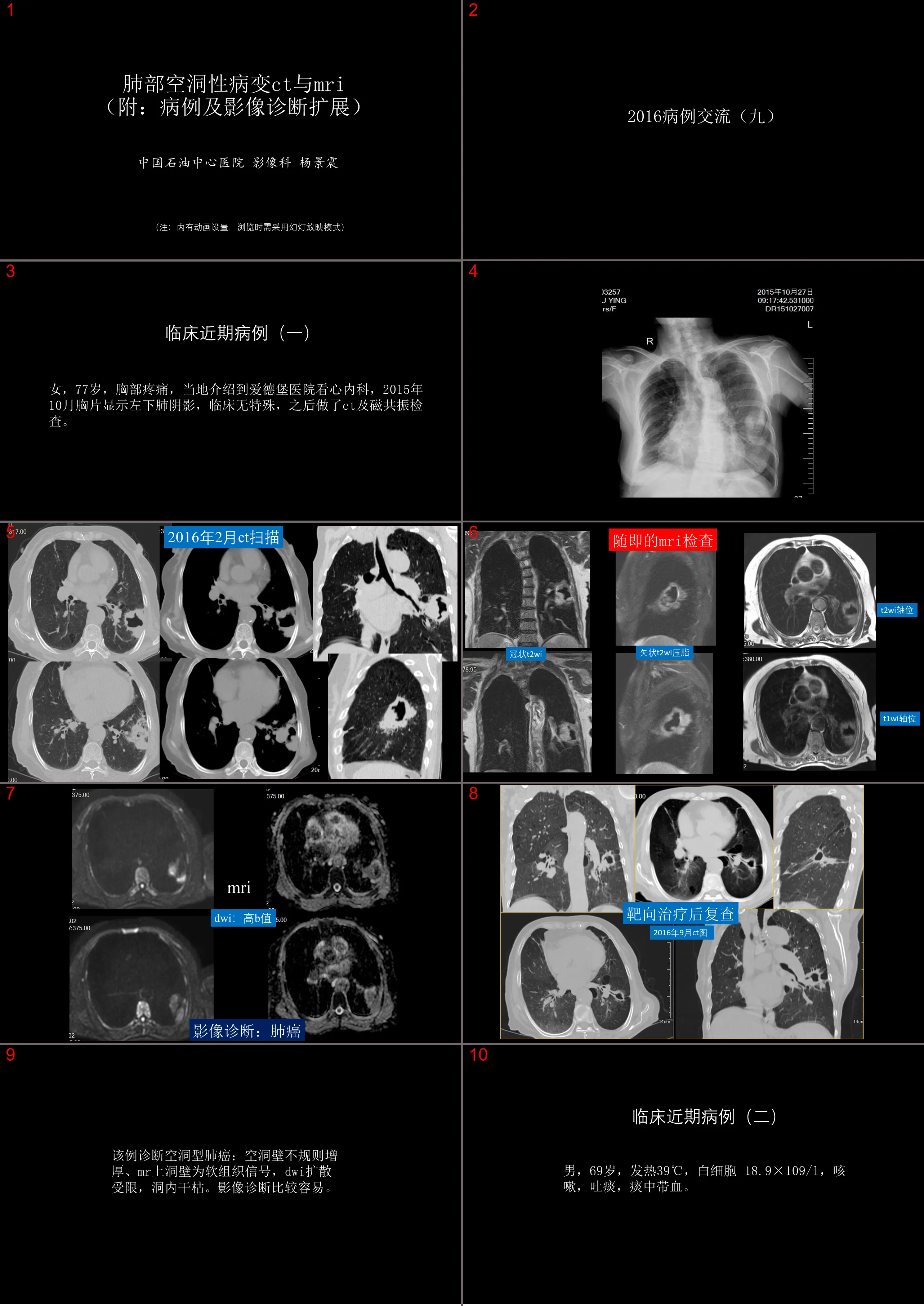 肺部空洞性病灶CT與MRI