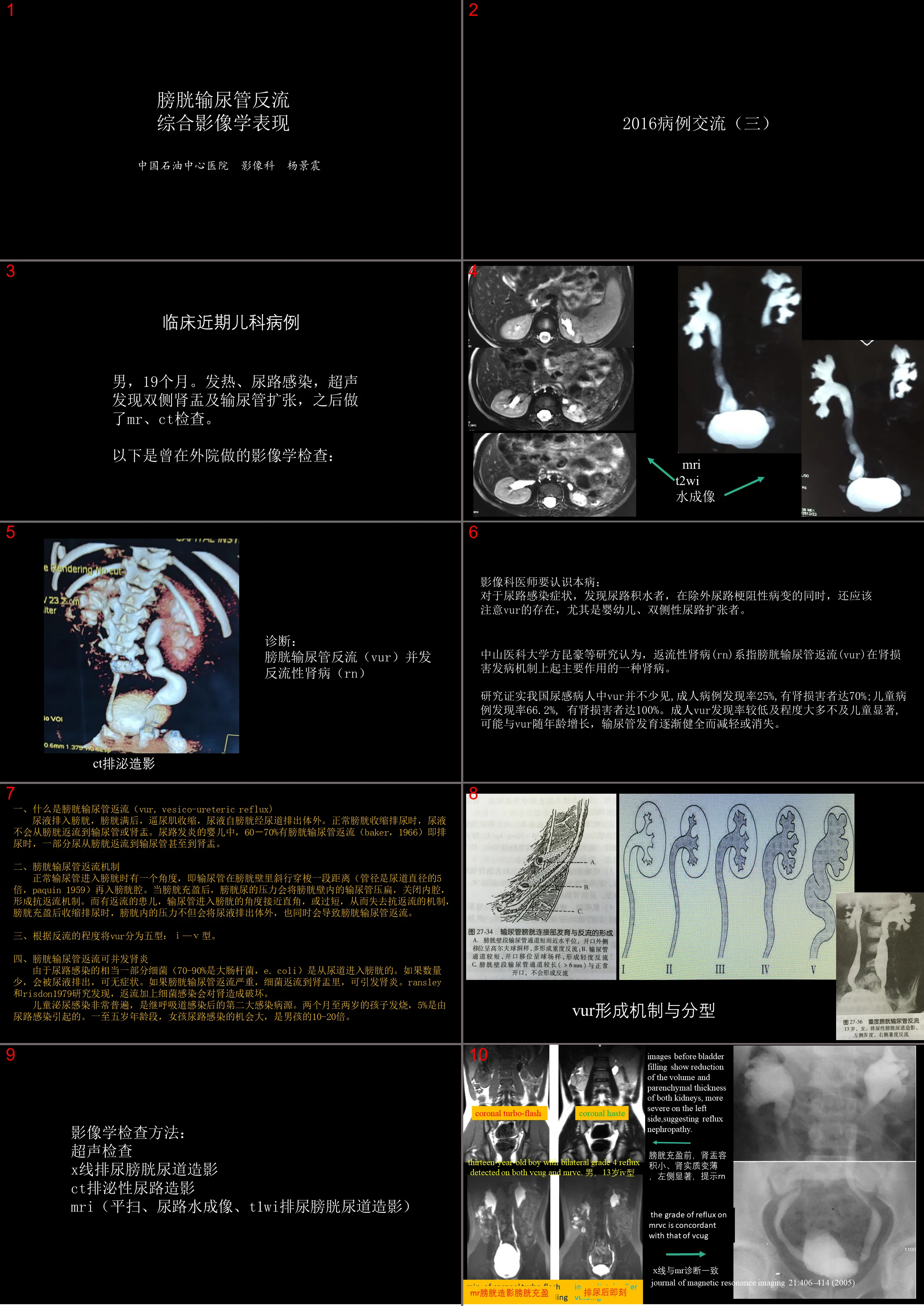 影像科容易忽略的病：膀胱输尿管反流